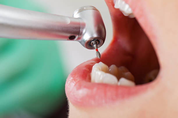 Best Emergency Dental Care for Broken or Chipped Teeth in North Seekonk, MA